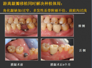 侯建霞 牙周病学高级班