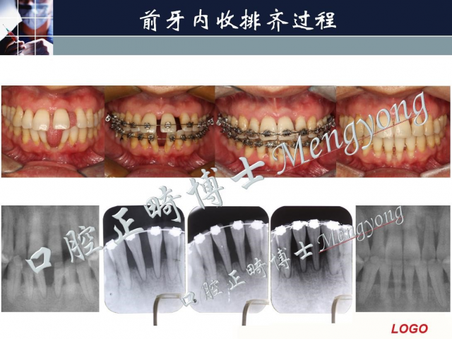 孟勇 从入门到精通--正畸实战系统课程