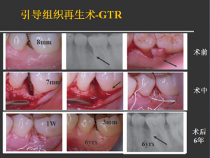 侯建霞 牙周病学高级班 11月上海