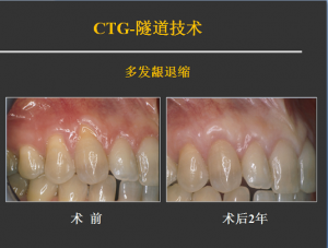 侯建霞 牙周病学高级班 11月上海