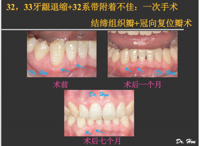 侯建霞 牙周病学高级班 11月上海